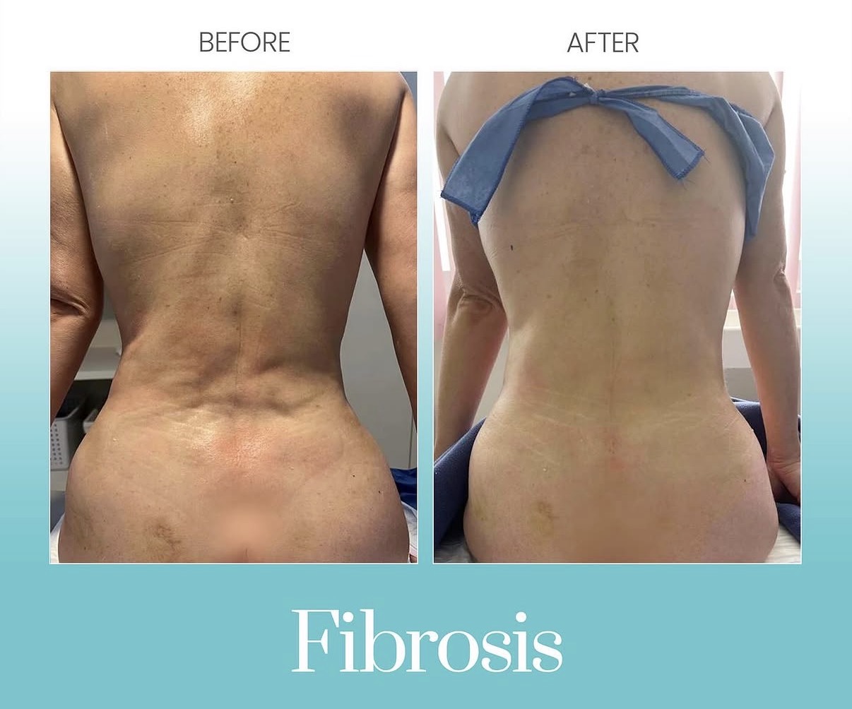 Antes y después del tratamiento de fibrosis postoperatoria